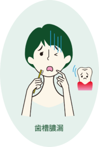 サンクロン 歯周病 歯槽膿漏 効果 イラスト